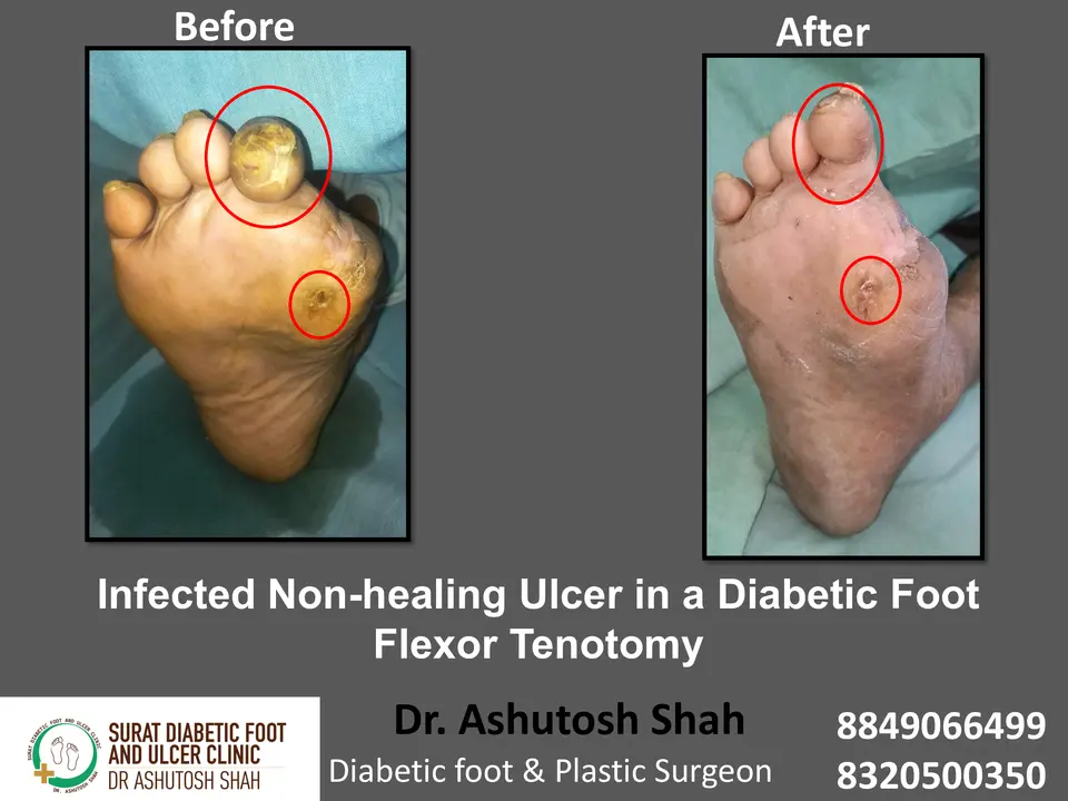 Diabetic Foot  PPT 3 checked by sir.pptx-7.webp